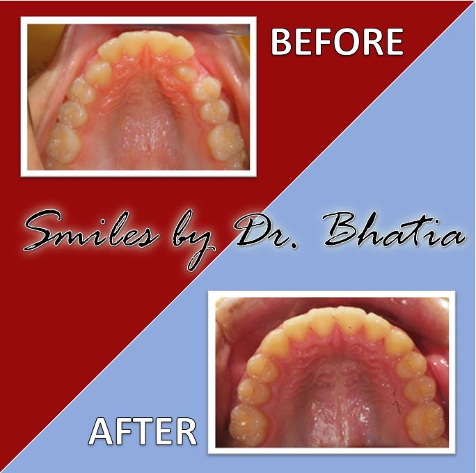 Before & After Gallery Dr. Sujata Bhatia, DDS, MS