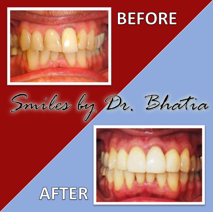 Before & After Gallery Dr. Sujata Bhatia, DDS, MS