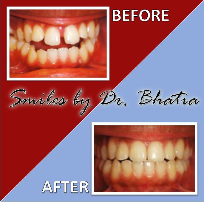 Before & After Gallery Dr. Sujata Bhatia, DDS, MS