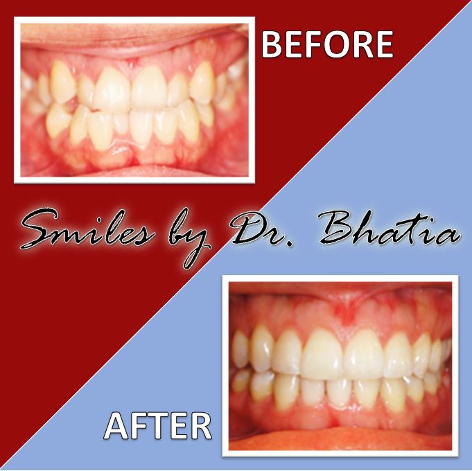 Before & After Gallery Dr. Sujata Bhatia, DDS, MS